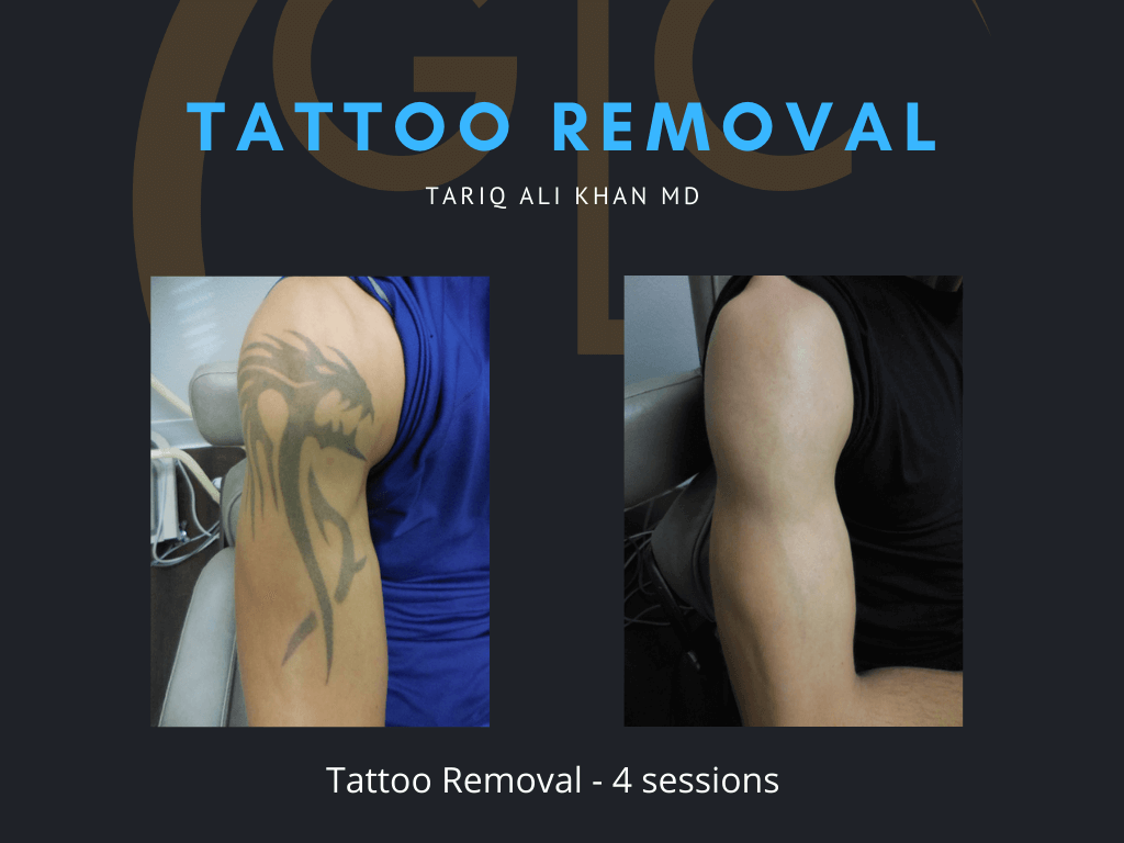 Gentle Care Laser Tustin Before and After picture - Tattoo Removal